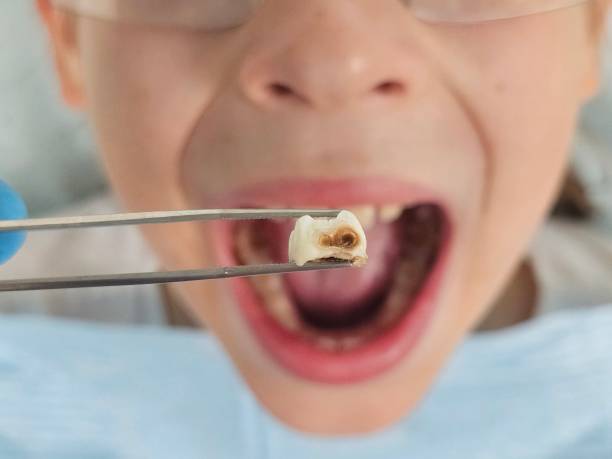 Best Emergency Tooth Extraction in Montura, FL